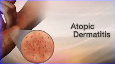 Kymera Therapeutics Announces U.S. 