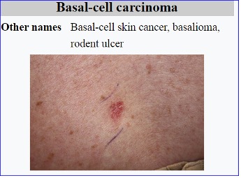 Medicus gains UAE DOH approval for basal cell carcinoma treatment trial