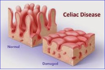 FDA Grants Fast Track Designation to Drug Candidate for Celiac Disease