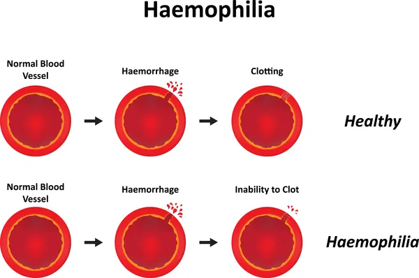 Real-World Data Support the Use of Sobi and Sanofi’s Elocta for Hemophilia A