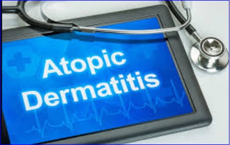 EASI scores fall 71% with APG777 for patients with atopic dermatitis