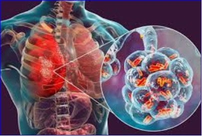 What to know about Legionnaires' disease, which has sickened dozens in New York City