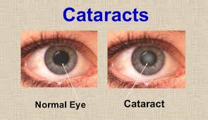 Drug treatment for cataracts moves a step closer