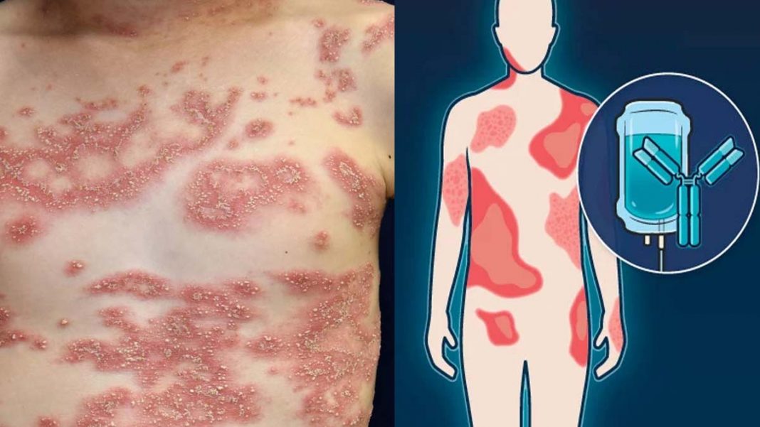 Boehringer Ingelheim's Spevigo Bags First FDA Approval for Rare Skin Disease