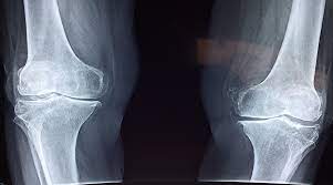 Sirana Pharma and Pfizer to work on treatment for brittle bone disease
