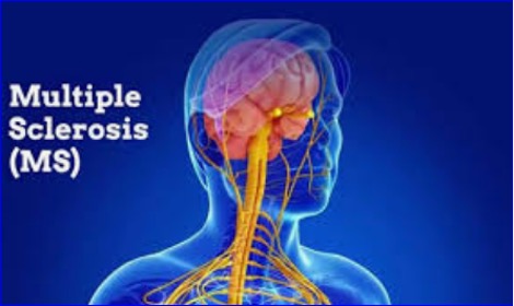 Earlier Ocrevus treatment may reduce cerebellar shrinkage in MS