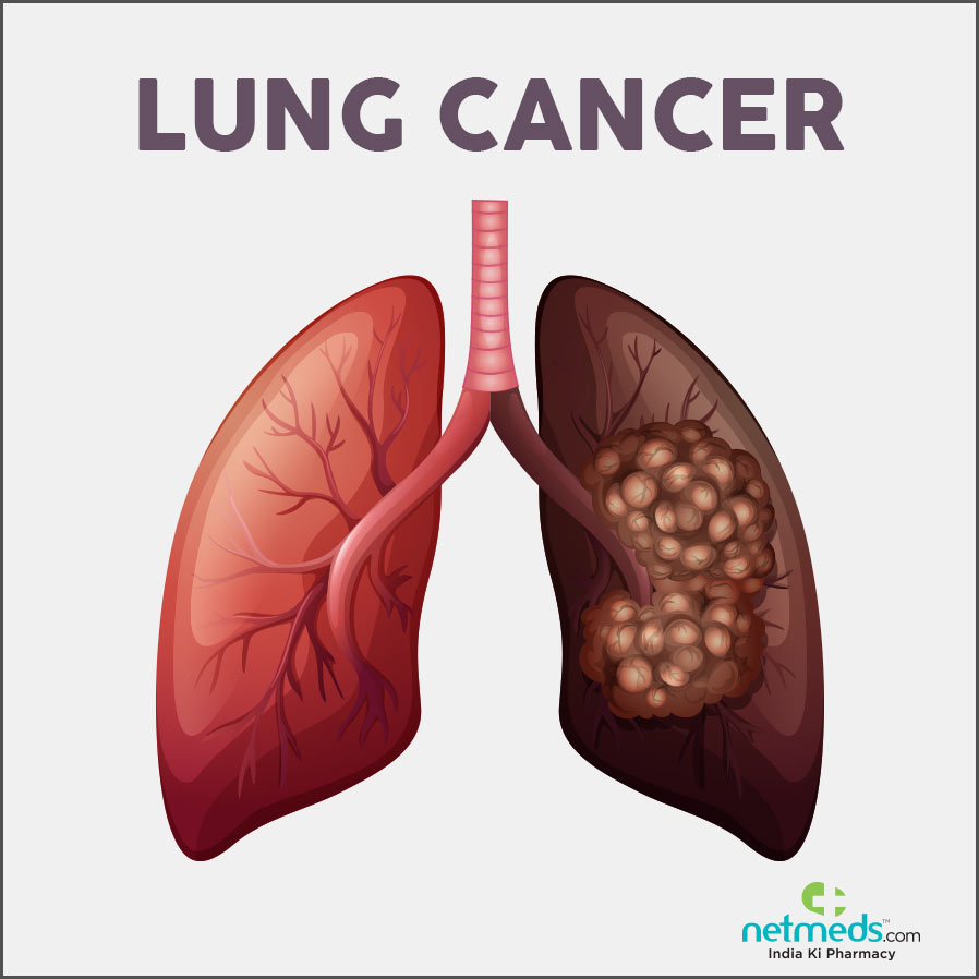Experimental drug combo inhibits growth of lethal lung cancer in mice