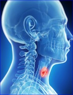 FDA Gives Fast Track Designation to LYT-200 in Advanced Head and Neck Cancers