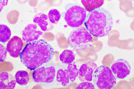 FDA grants Fast Track Designation to mocravimod with HSCT for acute myeloid leukemia