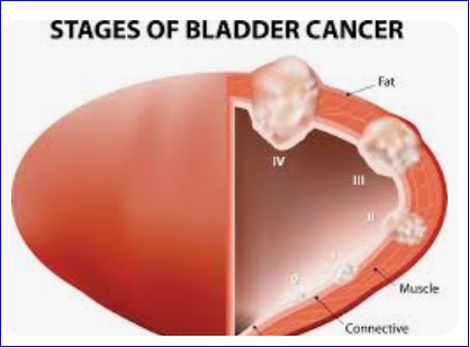 FDA approves treatment for bladder cancer