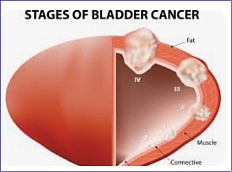 FDA approves treatment for bladder cancer