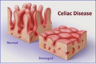 FDA Grants Fast Track Designation to Drug Candidate for Celiac Disease