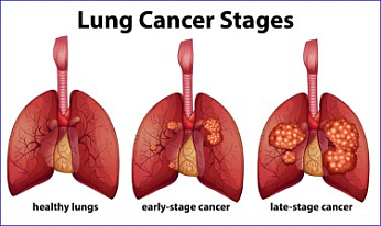 Researchers reveal structural interface in lung cancer protein as potential treatment target