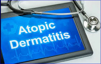 EASI scores fall 71% with APG777 for patients with atopic dermatitis