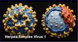 Modified herpes virus helps destroy glioblastoma in preclinical models