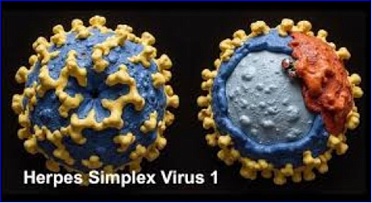 Modified herpes virus helps destroy glioblastoma in preclinical models