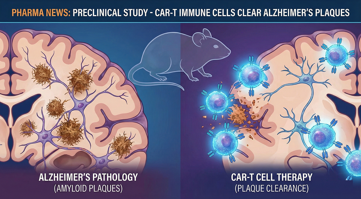 Preclinical Study: CAR-T Cell Therapy Clears Alzheimer’s Amyloid Plaques