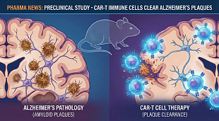 Preclinical Study: CAR-T Cell Therapy Clears Alzheimer’s Amyloid Plaques