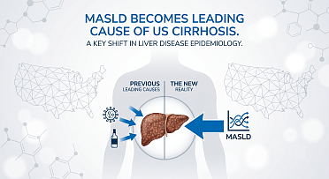 Cirrhosis Causes Shift: MASLD Becomes Leading Cause of US Liver Disease