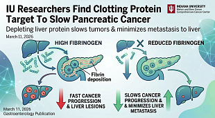 IU Researchers Identify Clotting Protein as Target in Pancreatic Cancer